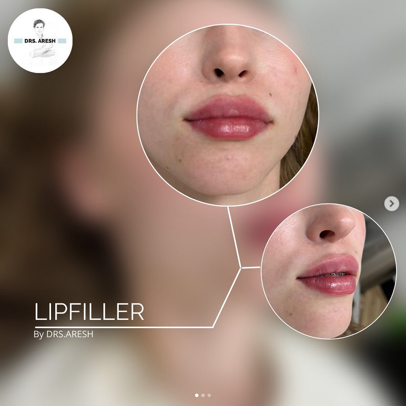 Ageworth lipfillers voor en na