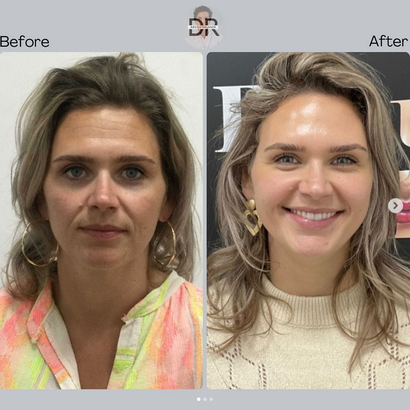 Botox door Dr. Aresh Salman