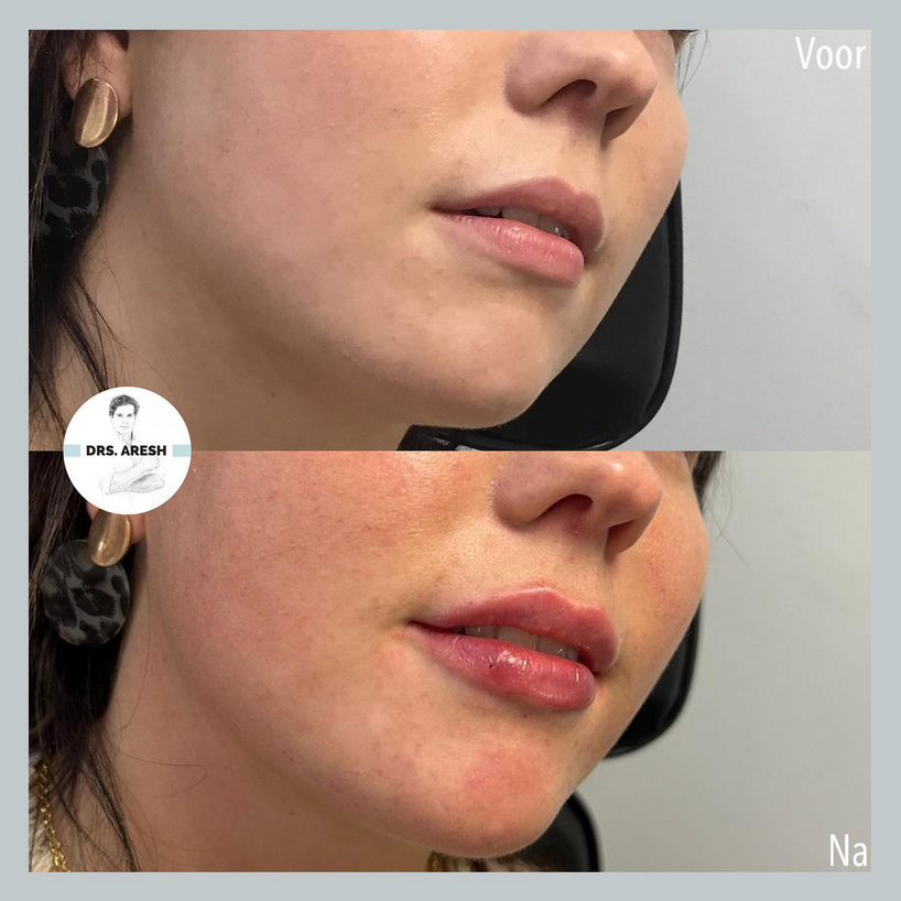 Dr Aresh lipfiller Ageworth
