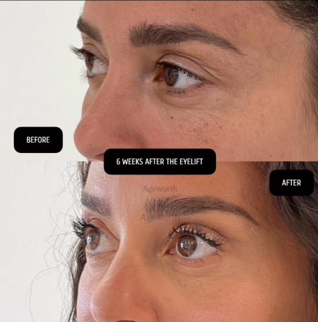 Fajah Lourens 6 weeks after