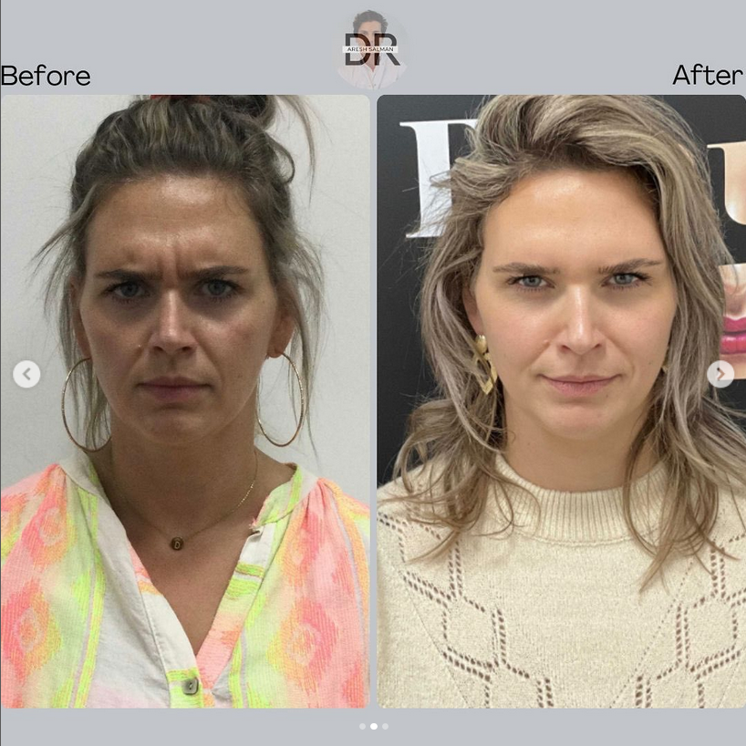 Fronsrimpel door Dr. Aresh Salman