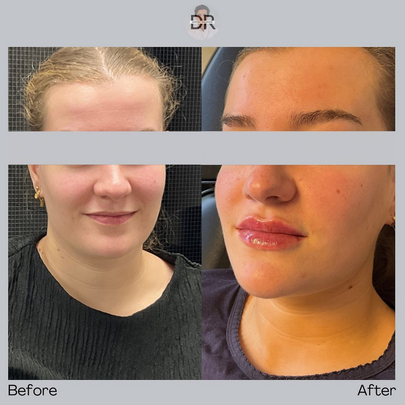 Lipfillers Ageworth