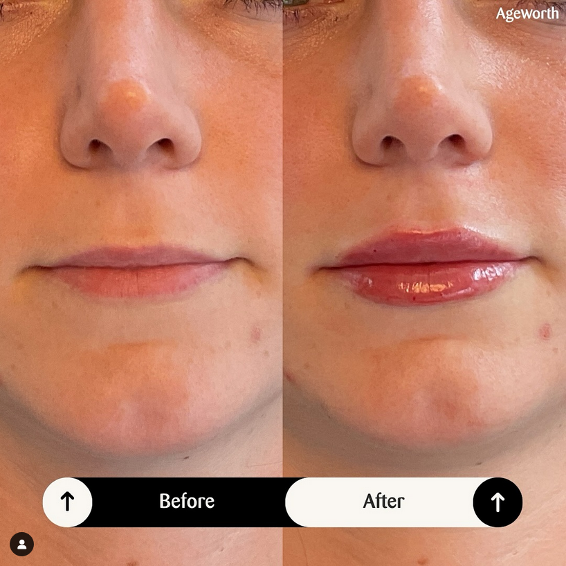 Lippen opvullen