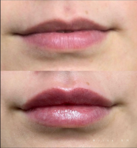 Lippen opvullen voor en na