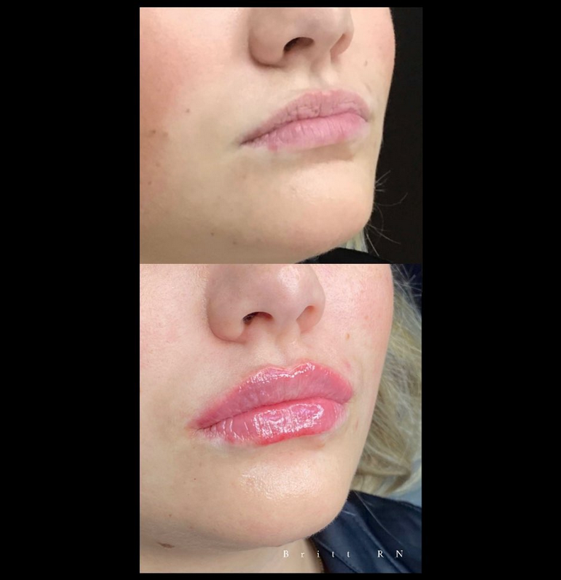 Lippen opvullen voor en na Ageworth Britt