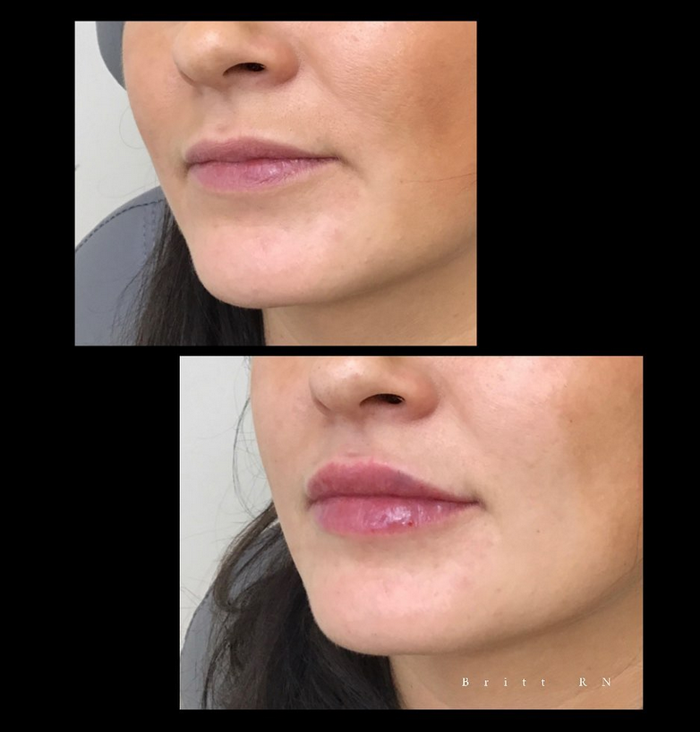 Lippen opvullen voor en na Ageworth