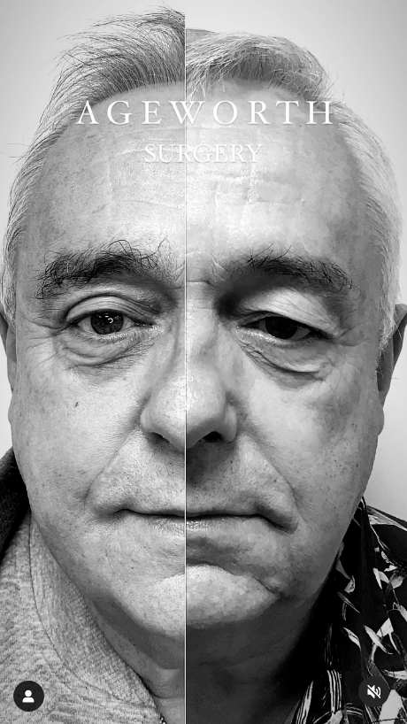 Ooglidcorrectie voor en na man