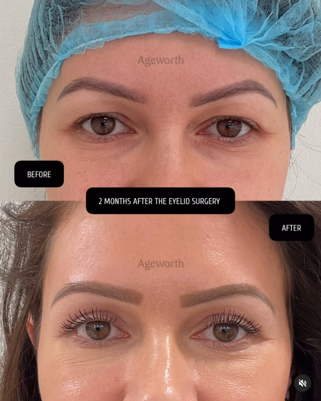 Ooglidcorrectie voor en na oktober ageworth Dr. David Hamraz