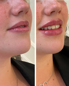 AgeWorth Before After