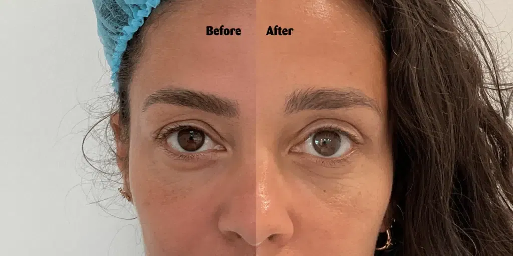 Fajah Lourens before after