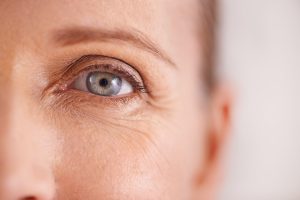 Botox prijs kraaienpootjes