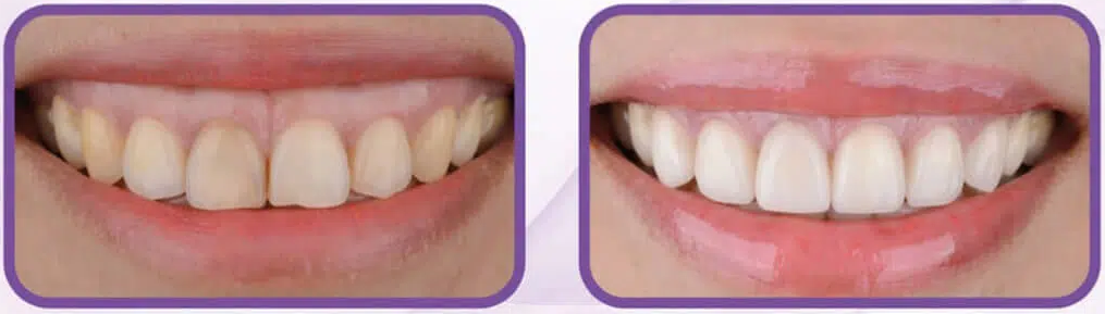 Gummy smile