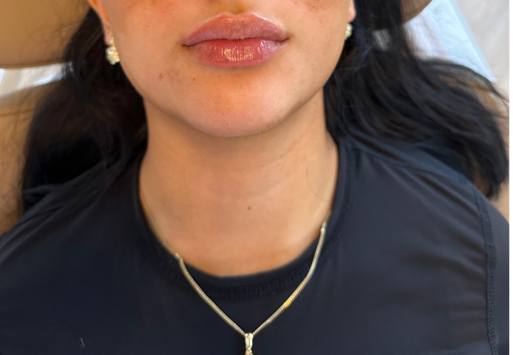 Natuurlijke lipfillers