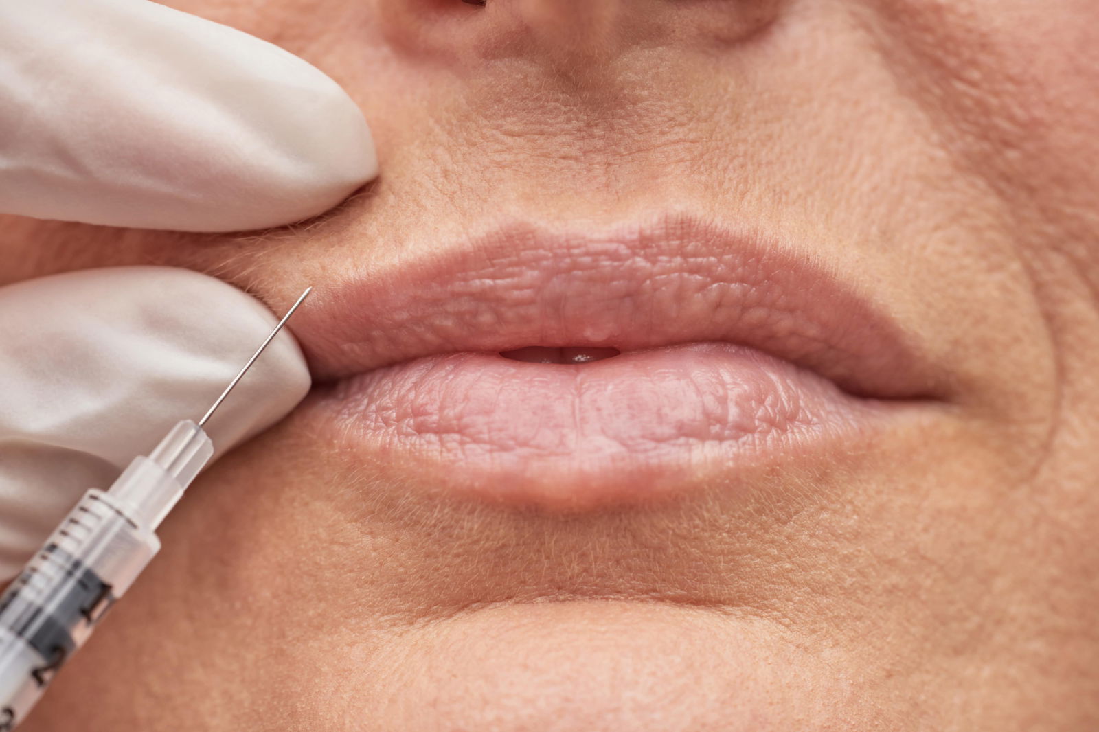 Lipfiller plaatsen Amersfoort