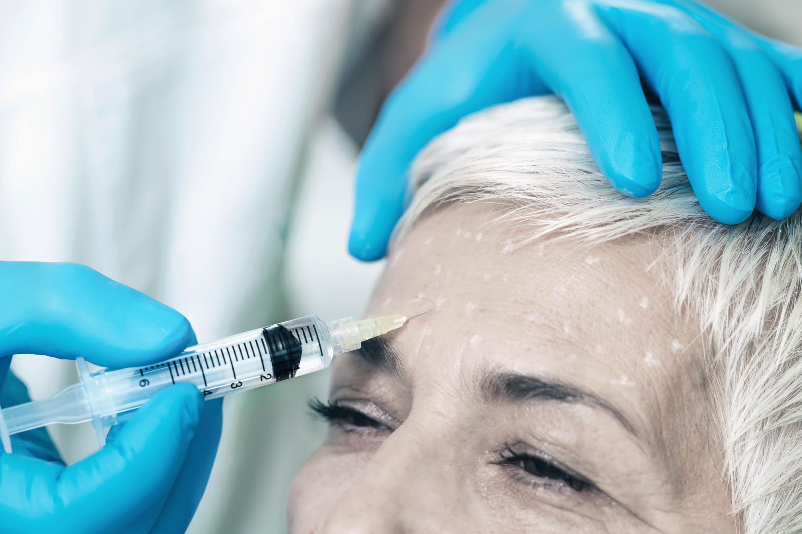 Hoeveel kost een fronsrimpel injectie met botox
