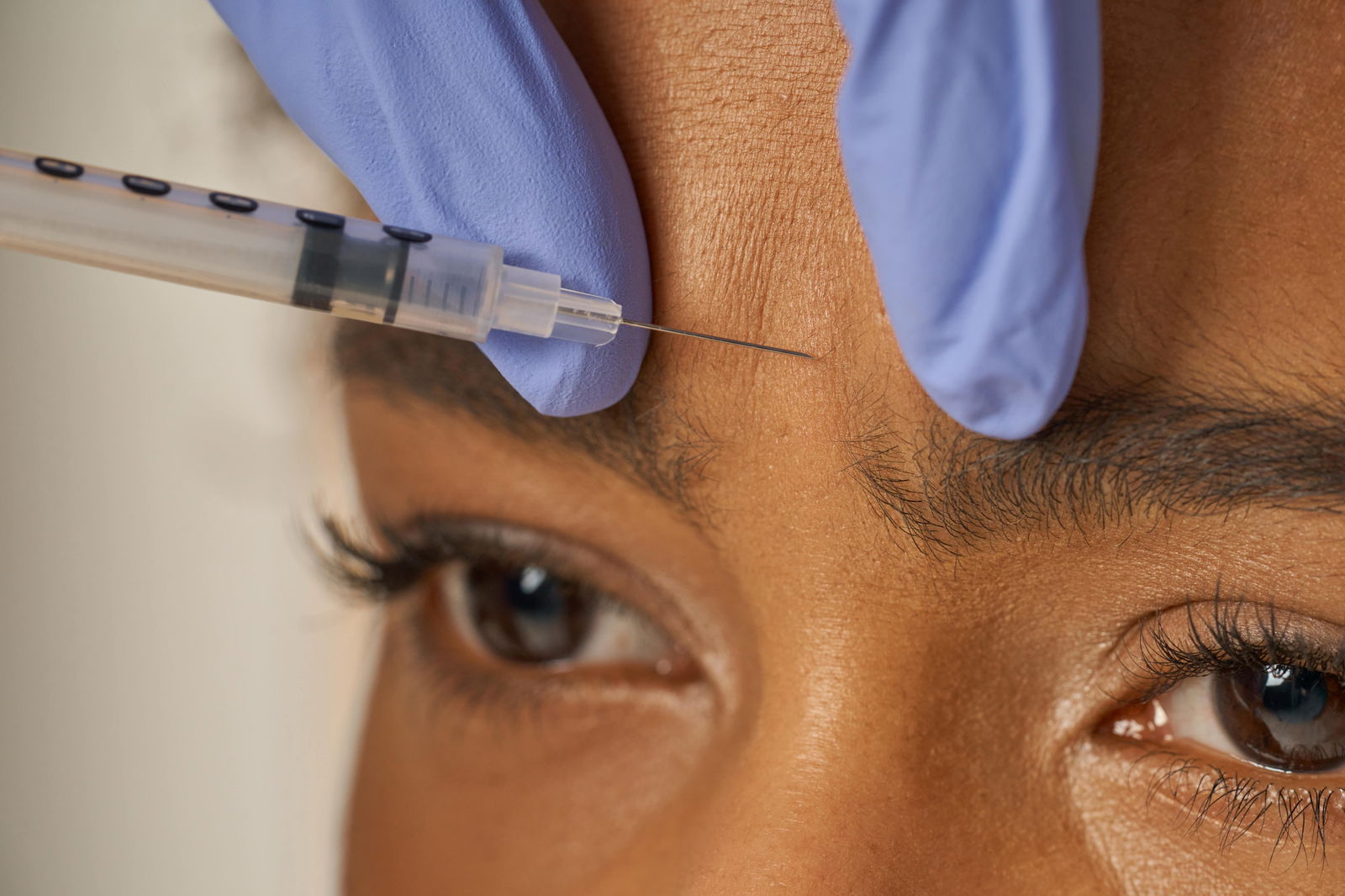 Botox prijs fronsrimpel